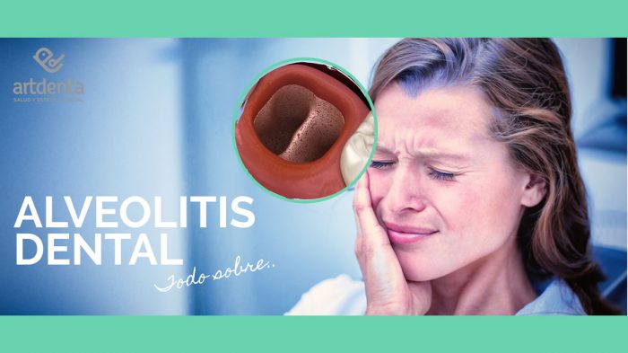 Alveolitis Dental: ¿Qué Es? Tipos. Causas. Síntomas. | Clínica Dental ...