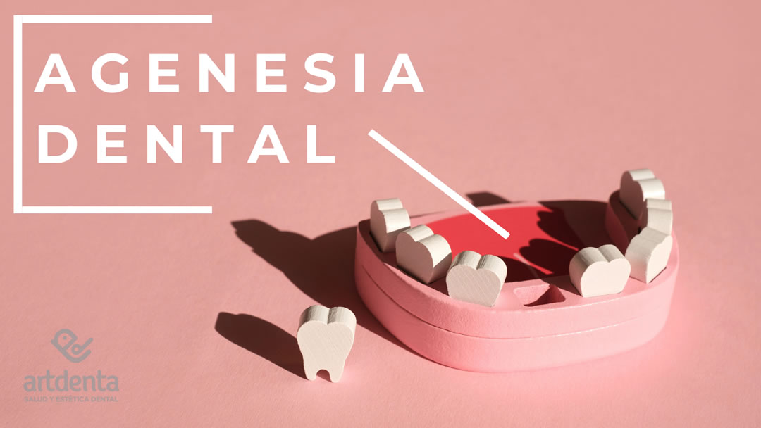 Banner Agenesia Dental | Clínica Dental Artdenta Valencia