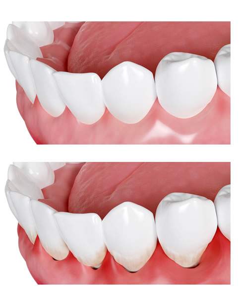 Pulpitis Dental | Cl&iacute;nica Dental Artdenta Valencia