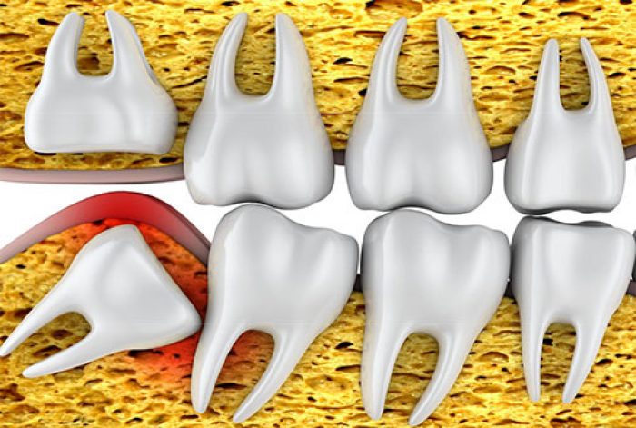 Apiñamiento Dental. ¿Qué es? Causas. Tratamiento. | Clínica Dental en ...