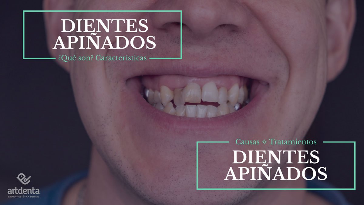 Banner Dientes Apiñados | Clínica Dental Artdenta Valencia
