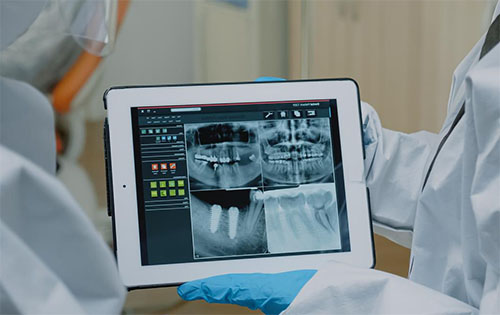 Radiografía de Dientes Apiñados | Clínica Dental Artdenta Valencia
