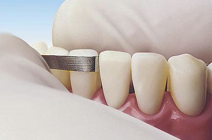 Stripping Dental | Clínica Dental Artdenta Valencia