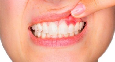 Quiste dental | Clínica Artdenta Valencia