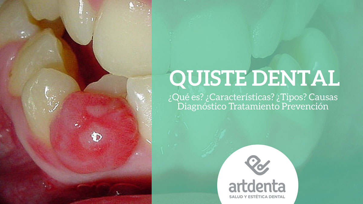 Banner Quiste dental | Clínica Artdenta Valencia