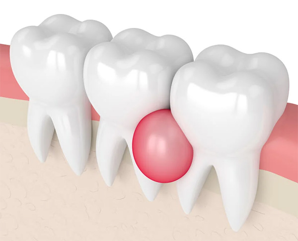 Inflamación Quiste dental | Clínica Artdenta Valencia