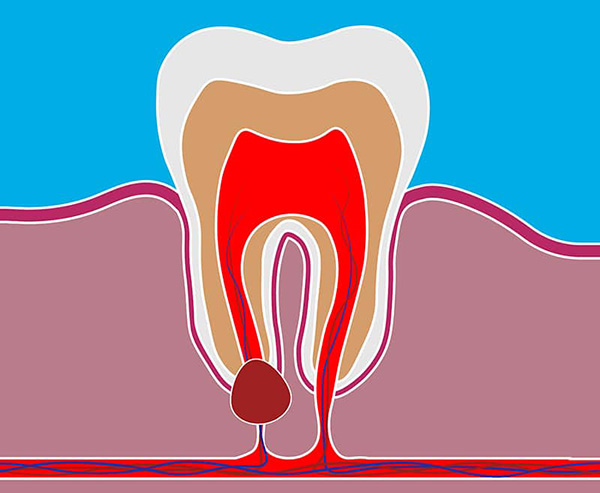 Quiste dental | Clínica Artdenta Valencia