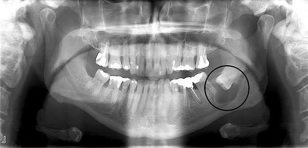 Radiografía Quiste dental | Clínica Artdenta Valencia