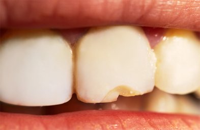 Fractura Dientes - Atricción dental | Clínica Dental Artdenta Valencia