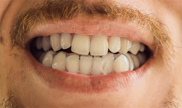 Bruxismo y Tronera Dental | Clínica Dental Artdenta Valencia