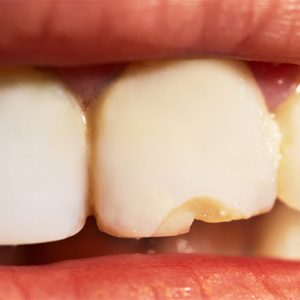 Fractura Dientes - Atricción dental | Clínica Dental Artdenta Valencia