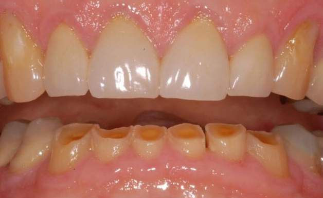 Dientes desgastados - Atricción dental | Clínica Dental Artdenta Valencia