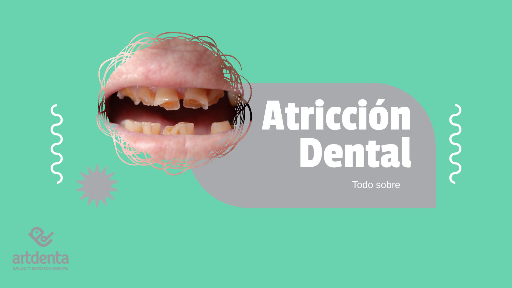 Banner Atricción dental | Clínica Dental Artdenta Valencia