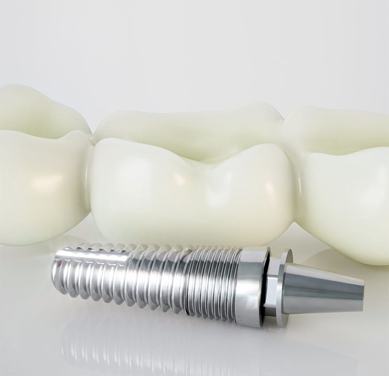 Osteointegración Factores de éxito Implantes Dentales| Clínica Dental Artdenta Valencia