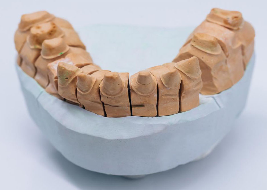 Molde Implantes y Factores de éxito Implantes Dentales| Clínica Dental Artdenta Valencia