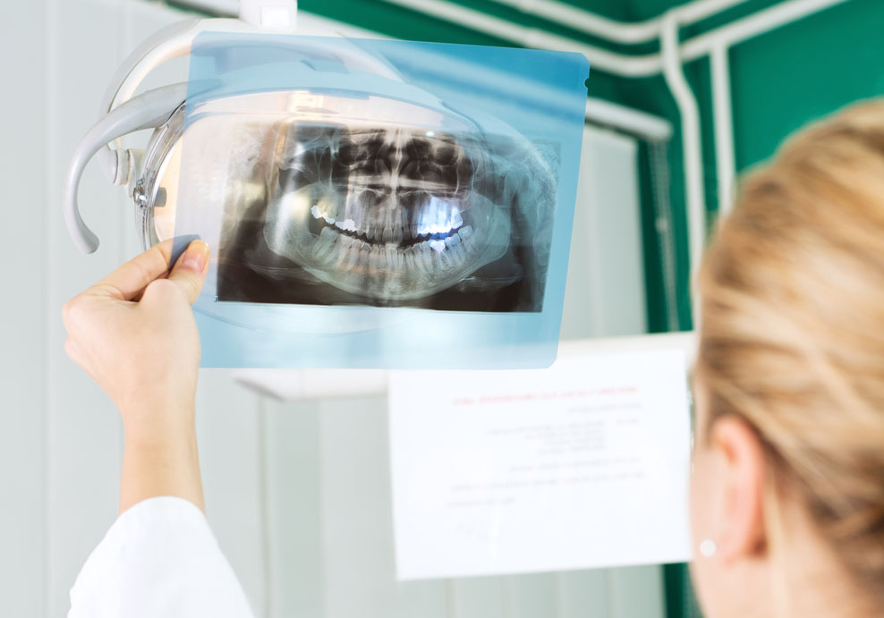 Radiografía Factores de éxito Implantes Dentales| Clínica Dental Artdenta Valencia