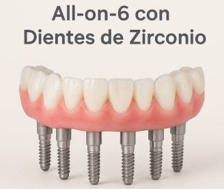 Implantes All on SIx 6 | Clínica Dental Artdenta Valencia