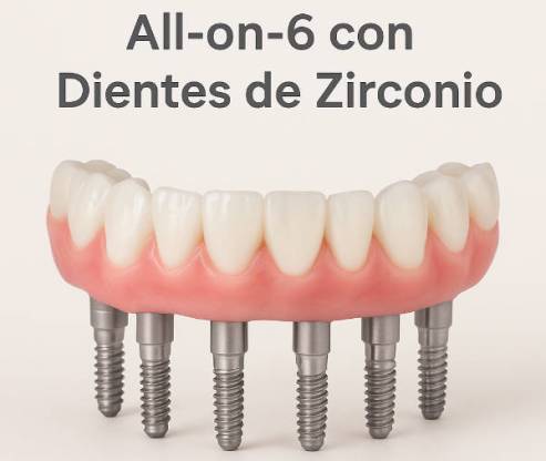 Implantes All on SIx 6 | Clínica Dental Artdenta Valencia