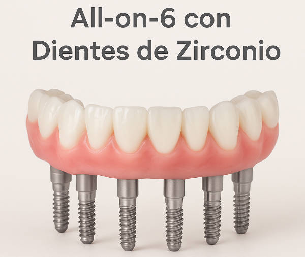 Implantes All on SIx 6 | Clínica Dental Artdenta Valencia