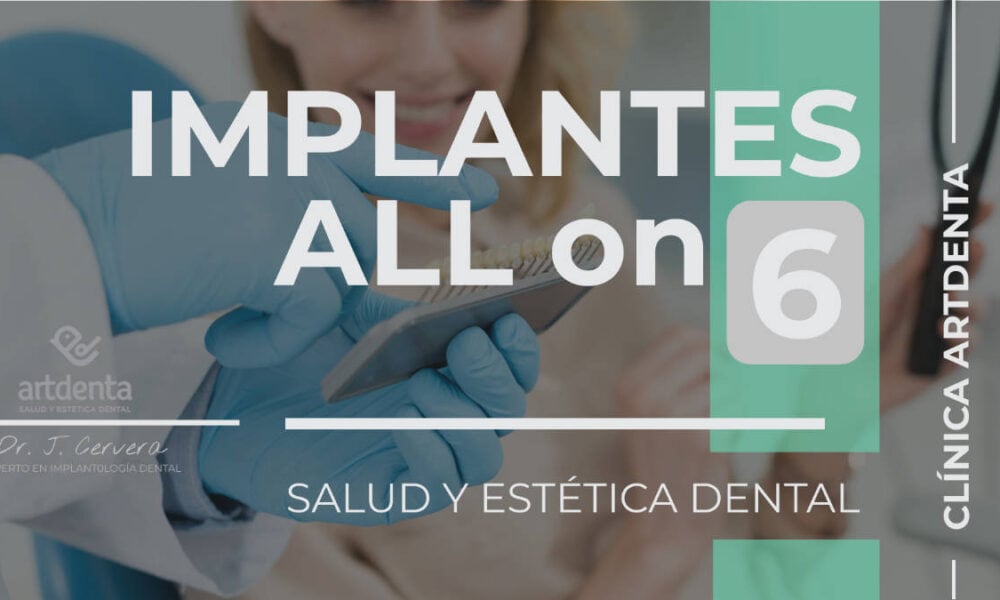 Banner Implantes All on SIx 6 | Clínica Dental Artdenta Valencia