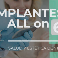 Banner Implantes All on SIx 6 | Clínica Dental Artdenta Valencia
