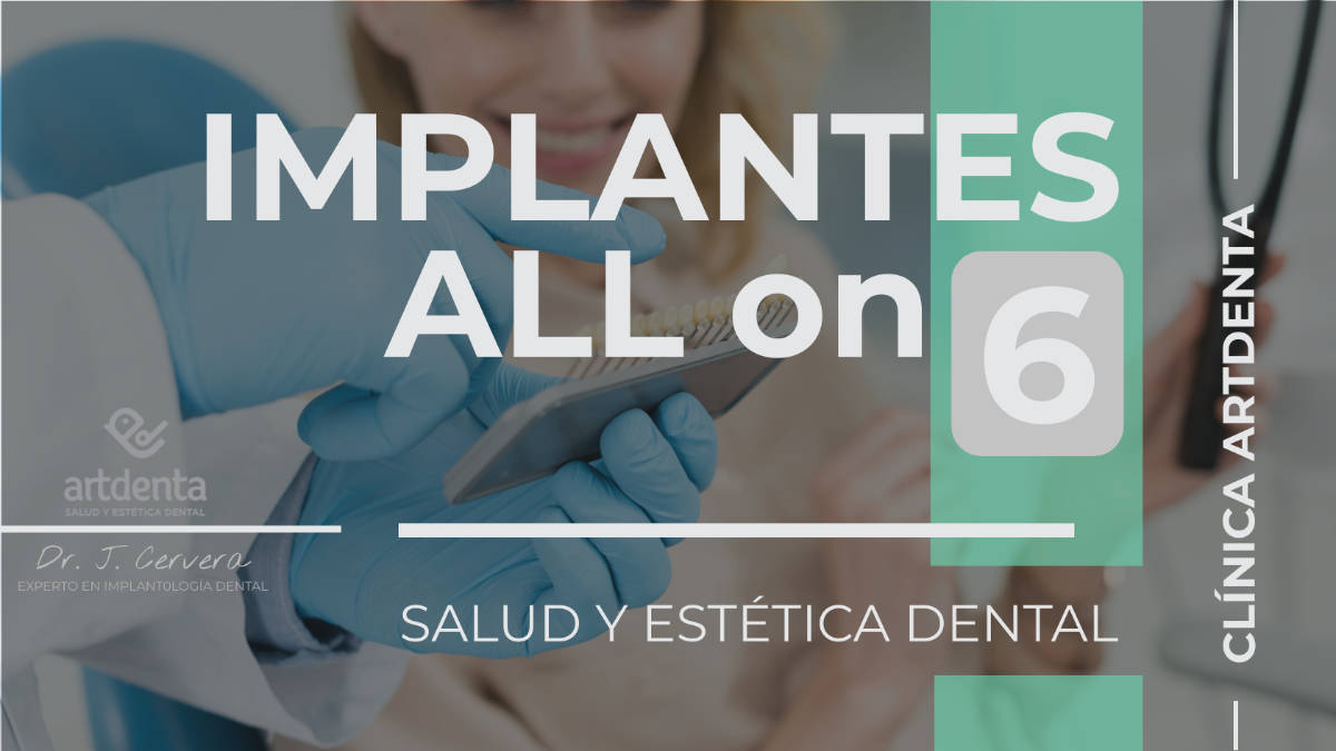 Banner Implantes All on SIx 6 | Clínica Dental Artdenta Valencia