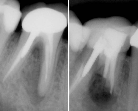 Cirugia periapical Cirugia Bucodental | Clínica Dental Artdenta Valencia