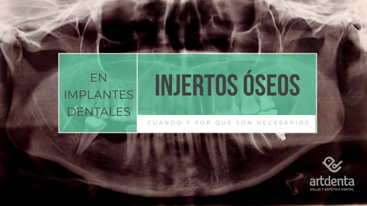 Banner Injerto óseo en implantologia | Clínica Dental Artdenta Valencia