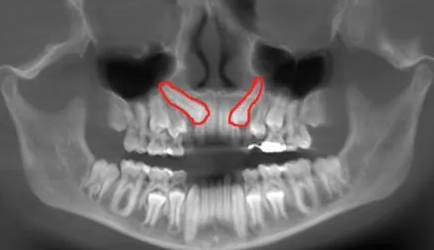 Exposición de dientes Ortodoncia | Clínica Dental Artdenta Valencia