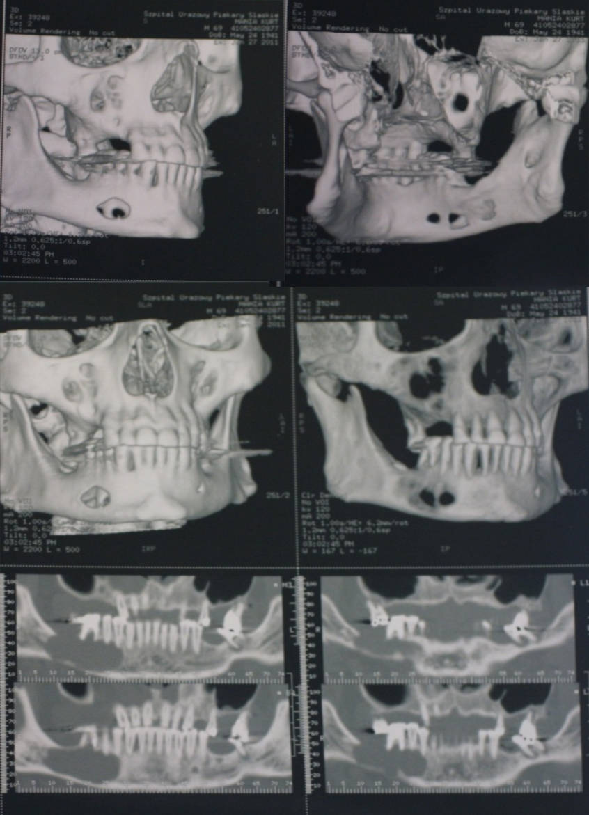 Quistectomías y manejo de cavidades óseas | Clínica Dental Artdenta Valencia