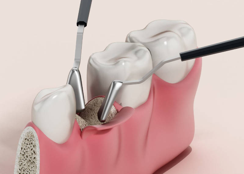 Recreación 3D | Injerto óseo en implantologia | Clínica Dental Artdenta Valencia