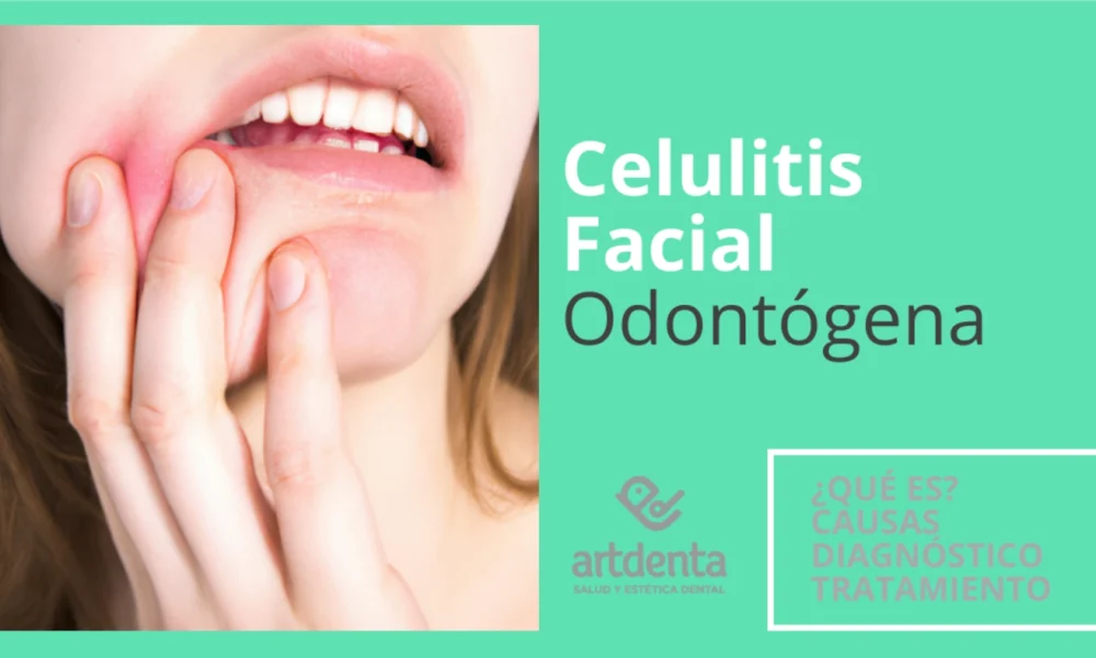 BannerCelulitis Facial Odontogénica | Clínica Dental Artdenta Valencia