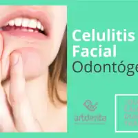 BannerCelulitis Facial Odontogénica | Clínica Dental Artdenta Valencia