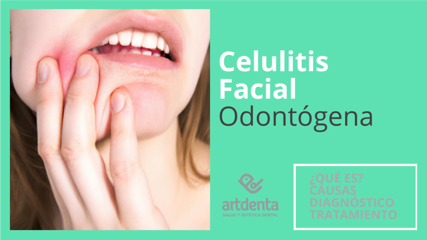 Celulitis Facial Odontog&eacute;nica | Cl&iacute;nica Dental Artdenta Valencia